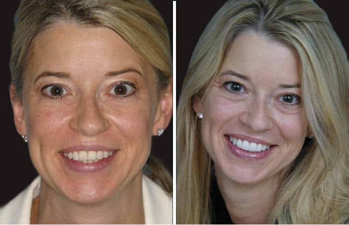 Collage of before and after cosmetic dental treatment photo