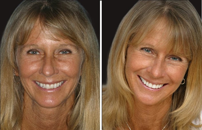 Collage of before and after cosmetic dental treatment photo