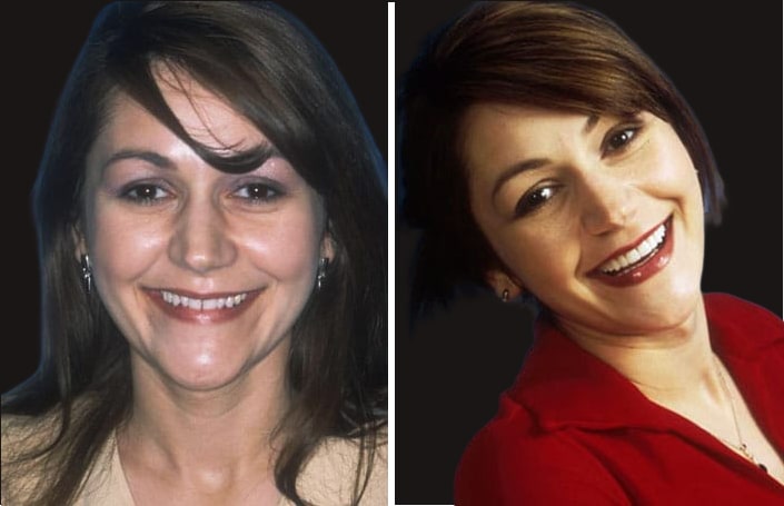 Collage of before and after cosmetic dental treatment photo