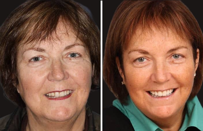 Collage of before and after cosmetic dental treatment photo