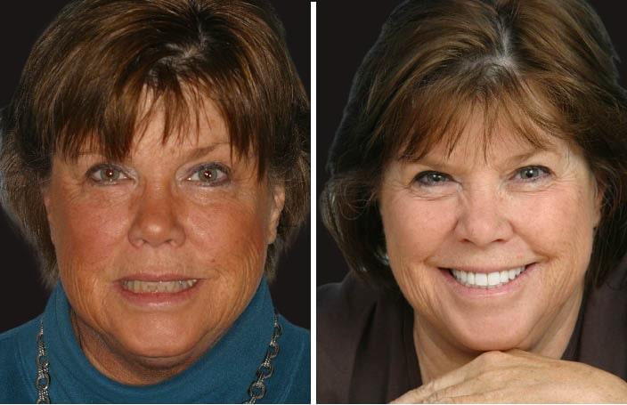 Collage of before and after cosmetic dental treatment photo