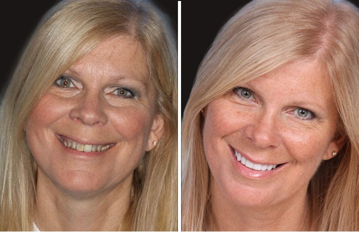 Collage of before and after cosmetic dental treatment photo