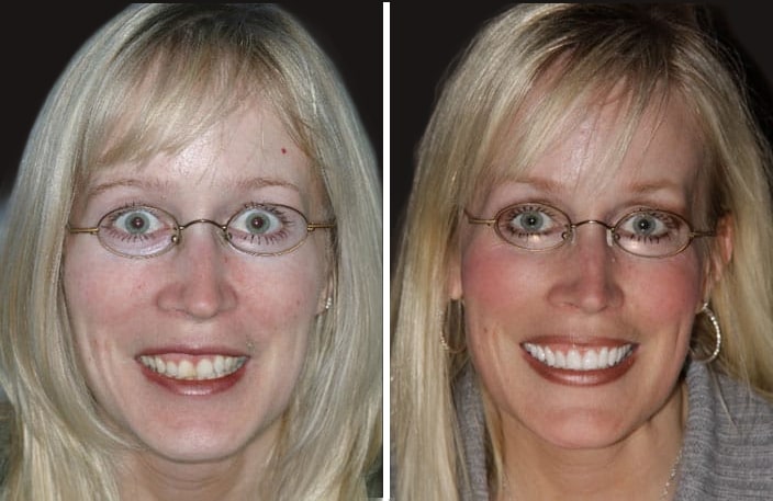 Collage of before and after cosmetic dental treatment photo