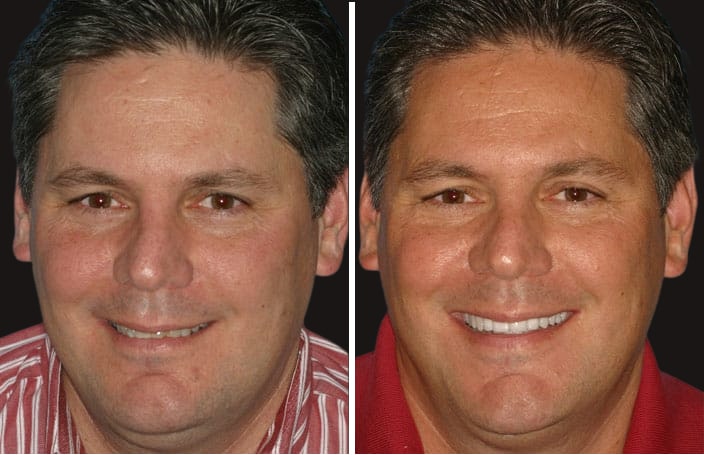 Collage of before and after cosmetic dental treatment photo