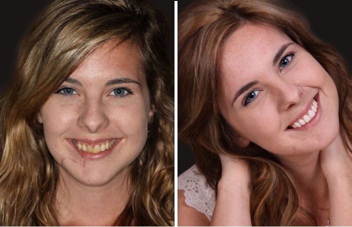 Collage of before and after cosmetic dental treatment photo