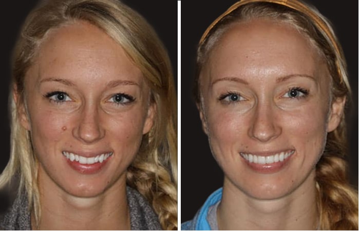 Collage of before and after cosmetic dental treatment photo