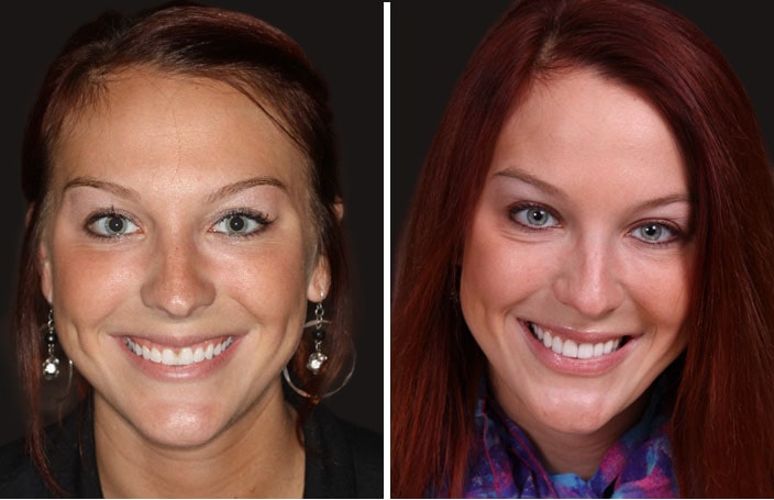 Collage of before and after cosmetic dental treatment photo