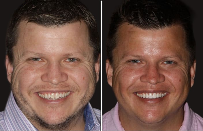 Collage of before and after cosmetic dental treatment photo