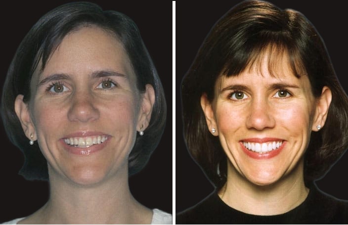 Collage of before and after cosmetic dental treatment photo