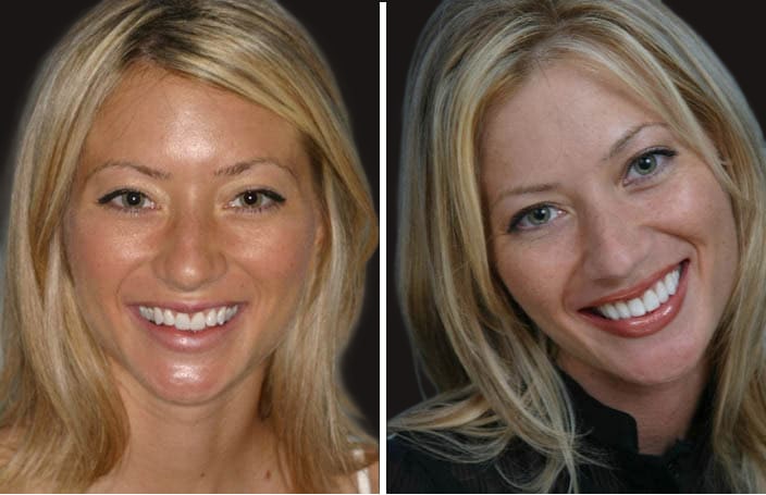 Collage of before and after cosmetic dental treatment photo