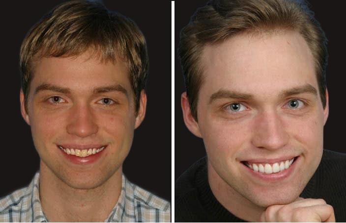 Collage of before and after cosmetic dental treatment photo