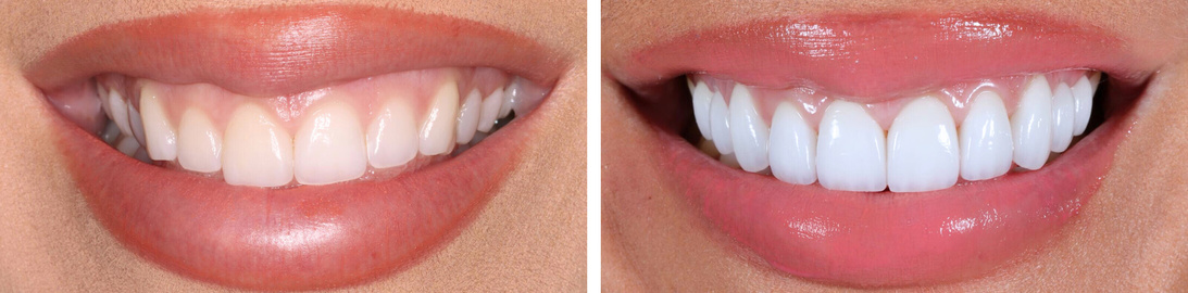 Smile of our patient