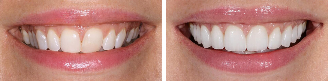 Smile of our patient