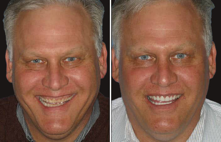 Collage of before and after cosmetic dental treatment photo