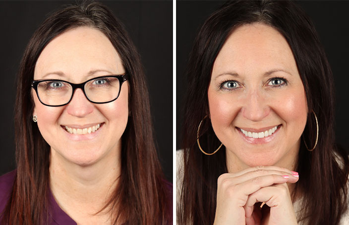 Collage of before and after cosmetic dental treatment photo