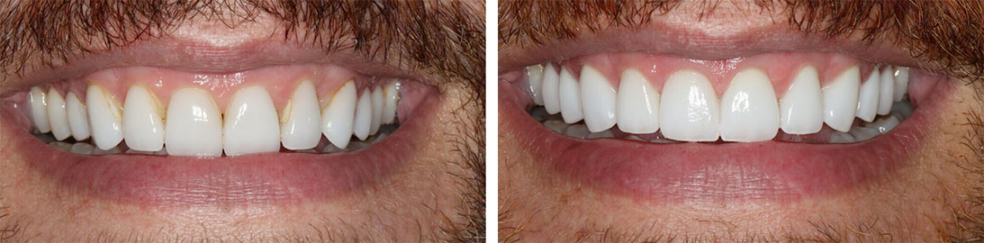 Smile of our patient