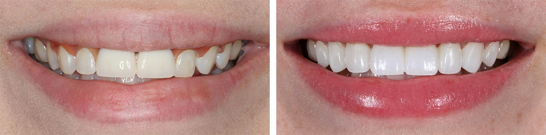 Smile of our patient