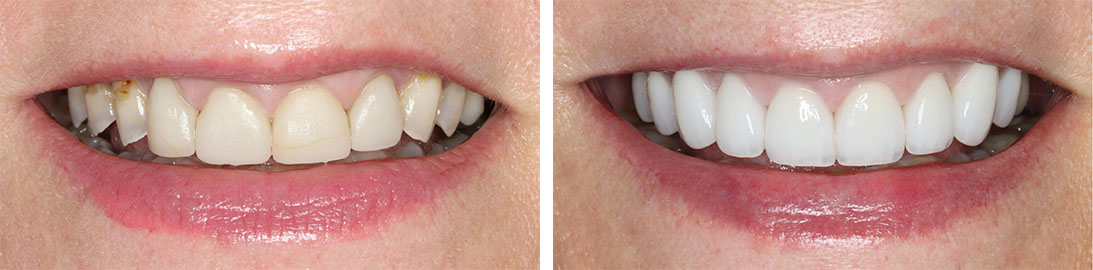 Smile of our patient