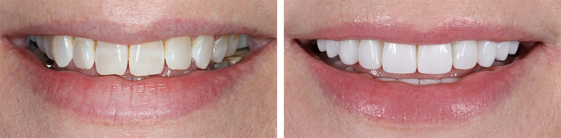 Smile of our patient