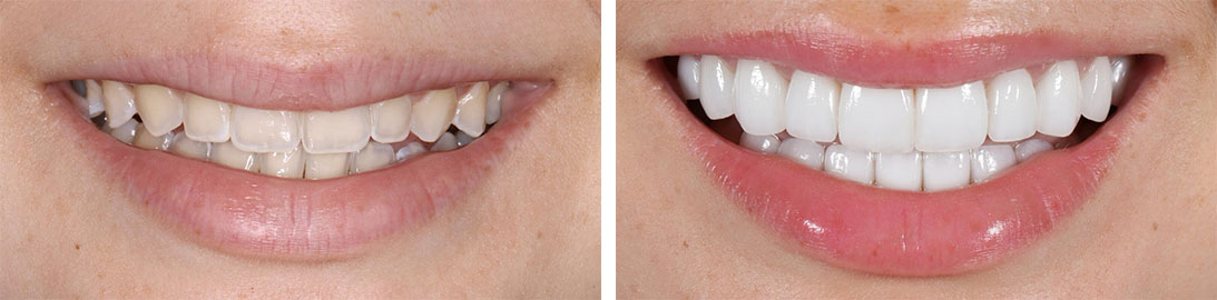 Smile of our patient