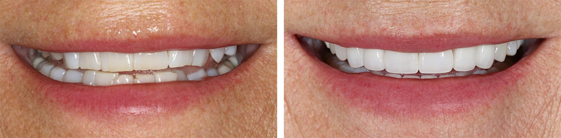 Smile of our patient