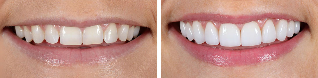 Smile of our patient