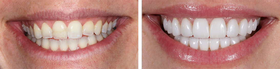 Smile of our patient