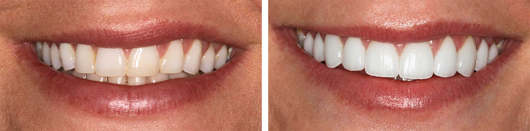 Smile of our patient