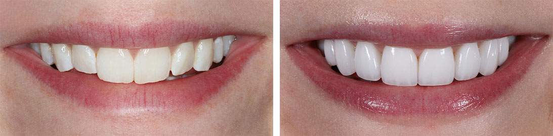 Smile of our patient