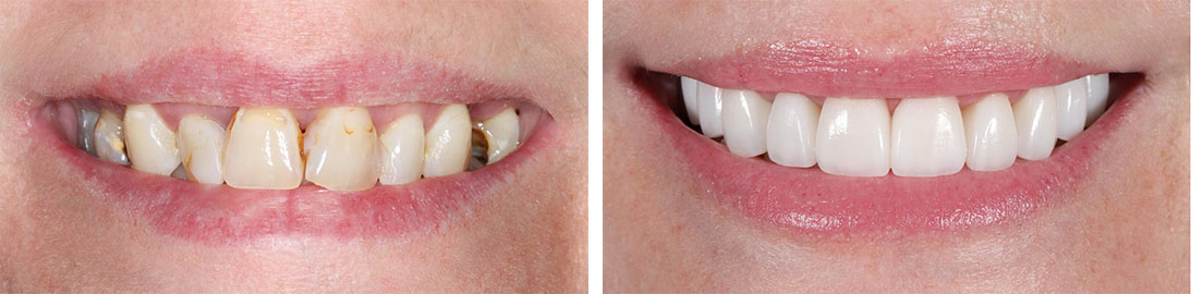 Smile of our patient