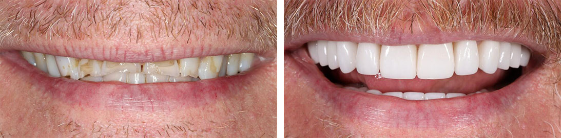 Smile of our patient