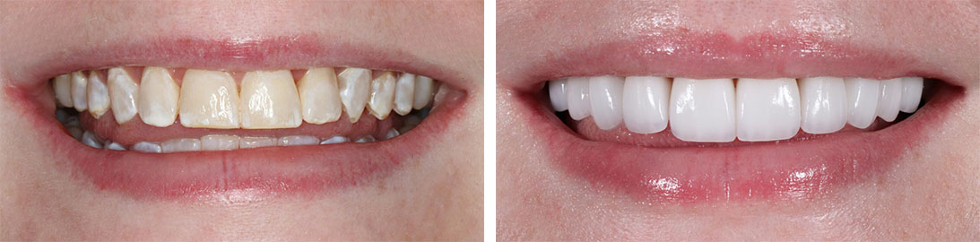 Smile of our patient