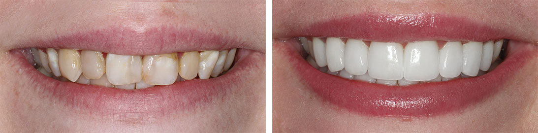 Smile of our patient