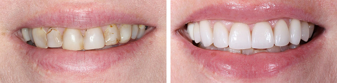 Smile of our patient