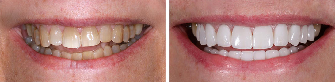 Smile of our patient