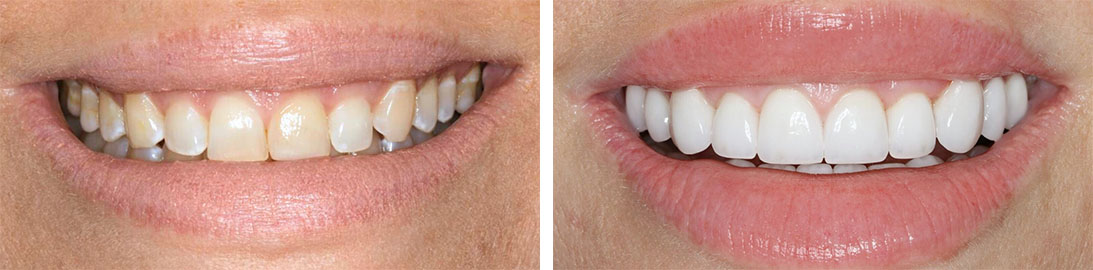 Smile of our patient