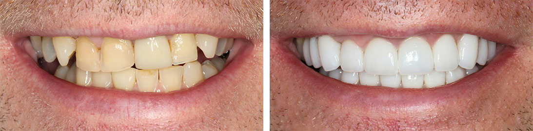 Smile of our patient