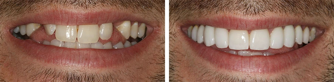 Smile of our patient