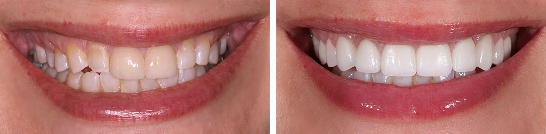 Smile of our patient