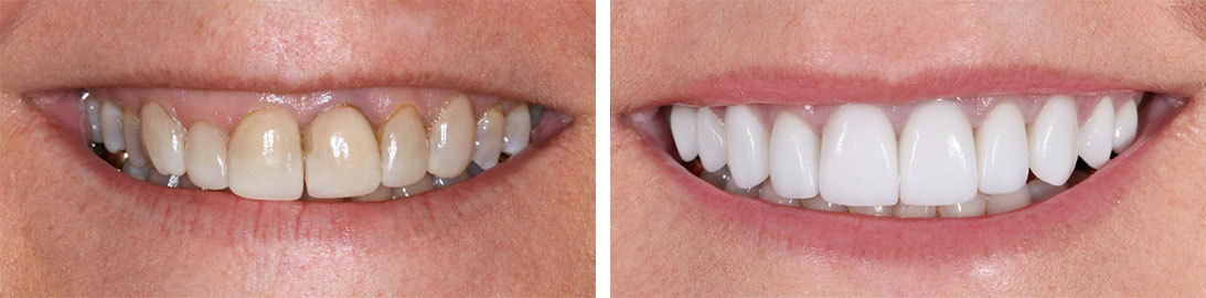 Smile of our patient