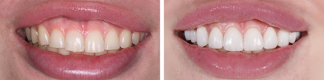 Smile of our patient