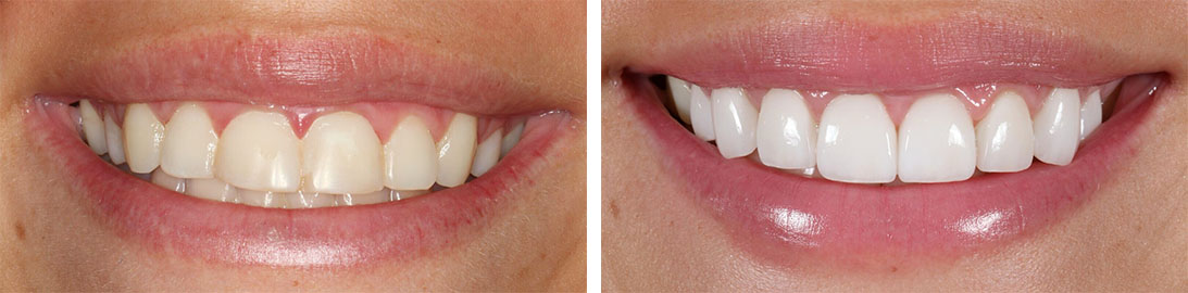 Smile of our patient