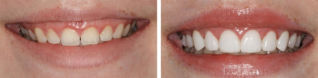 Smile of our patient