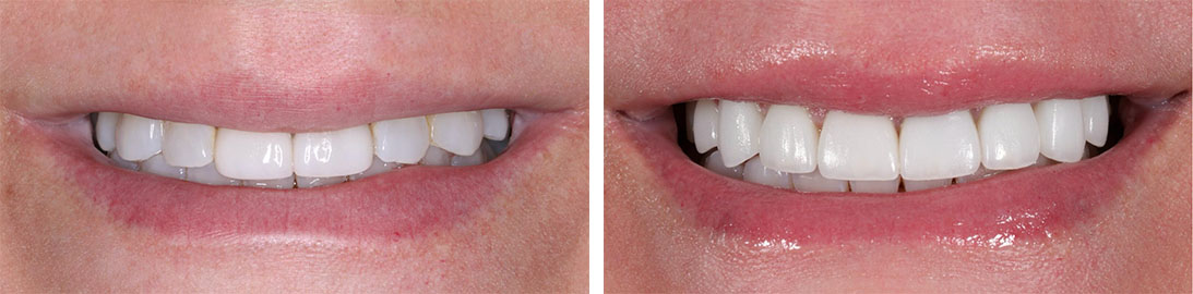 Smile of our patient