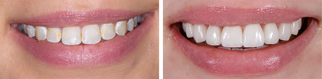 Smile of our patient