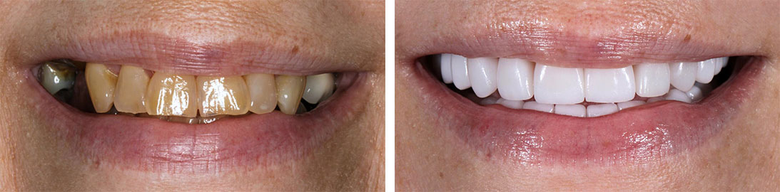 Smile of our patient