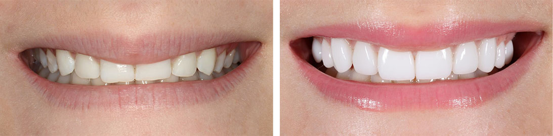 Smile of our patient