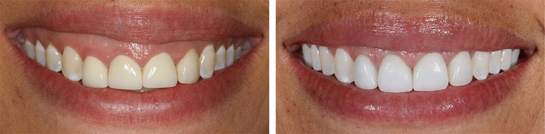 Smile of our patient