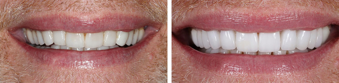 Smile of our patient