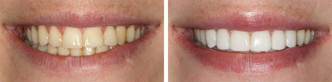 Smile of our patient